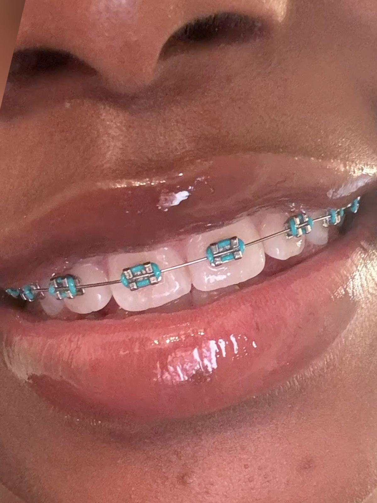 High quality realistic clipons Cosplay Braces,