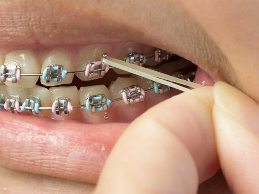Rubber band braces