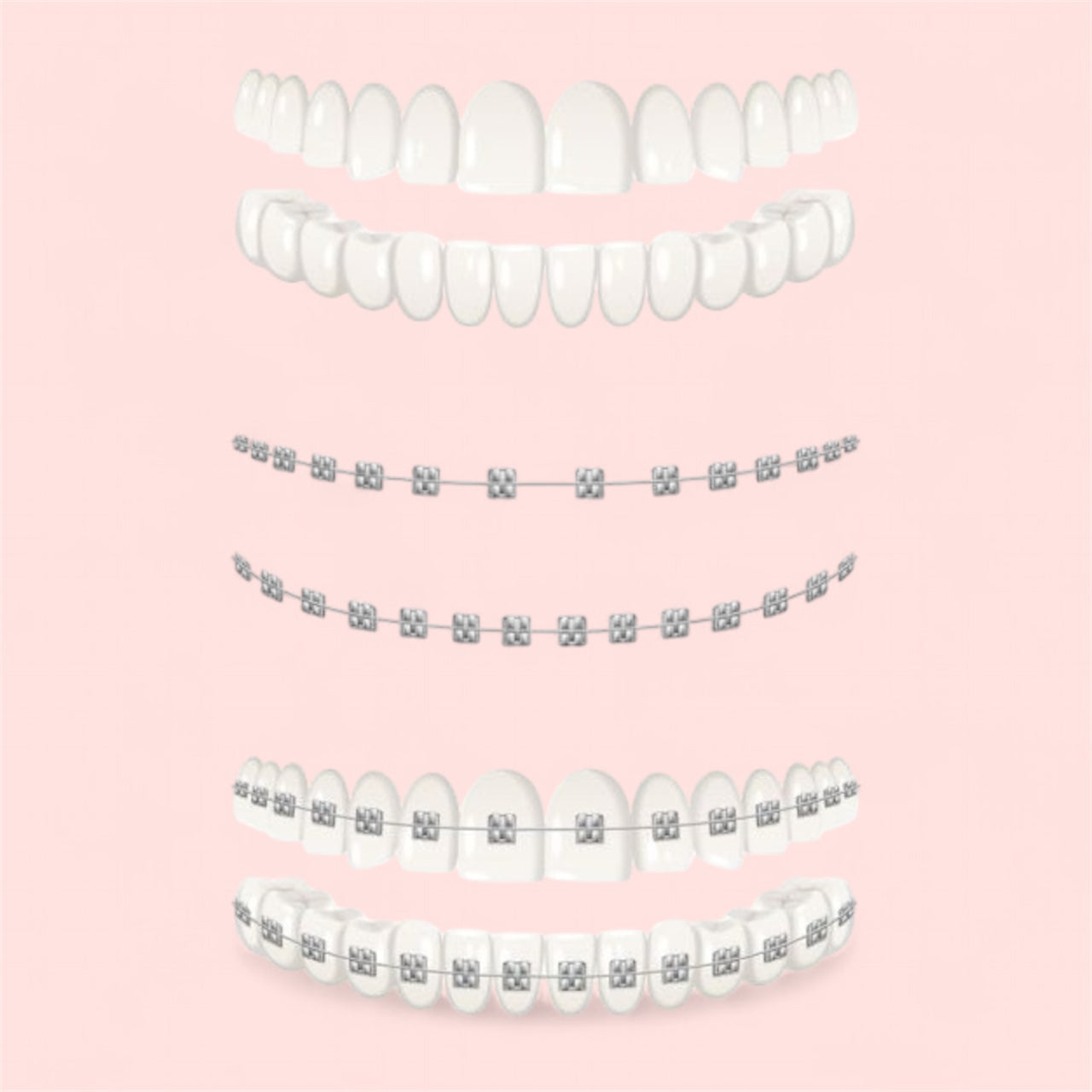 High quality realistic clipons Cosplay Braces,